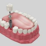 1753299137_jak-wybrac-klinike-implantow-stomatologicznych.webp.webp